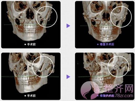 颧骨移动术手术方案