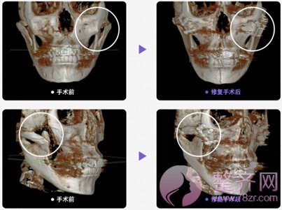 颧骨移动术手术方案