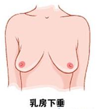 乳房下垂矫正的方法有哪些？