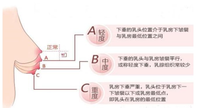 乳房下垂矫正的方法有哪些？