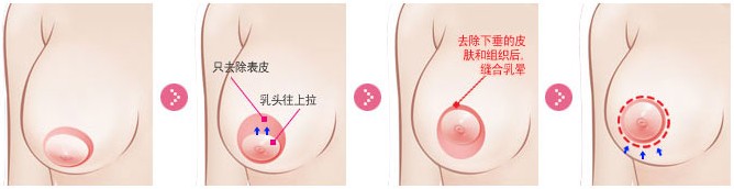 乳房下垂矫正的方法有哪些？