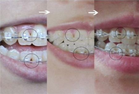 牙齿矫正后，我的脸型及牙齿变化全过程