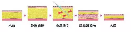 吸脂，你真的了解吗？