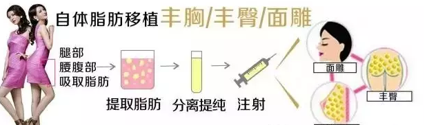 自体脂肪填充有哪些秘密？你知道多少