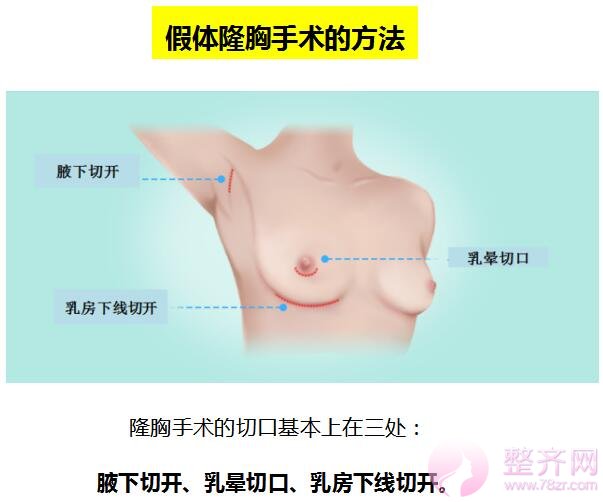 假体隆胸手术方法分析