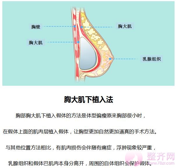 假体隆胸手术方法分析