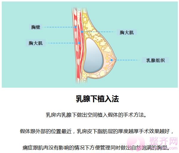 假体隆胸手术方法分析