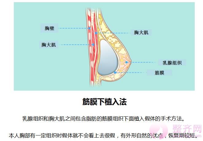 假体隆胸手术方法分析