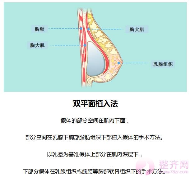 假体隆胸手术方法分析