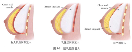 哪些闻所未闻的隆胸方法，原来还可以这样