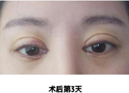 成都美莱医院韩国栋医生做的全切双眼皮开眼角