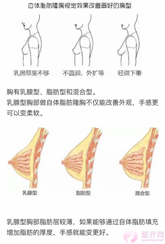 自体脂肪隆胸的基础知识