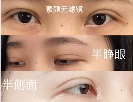 价格5000元做的双眼皮开眼角提肌手术