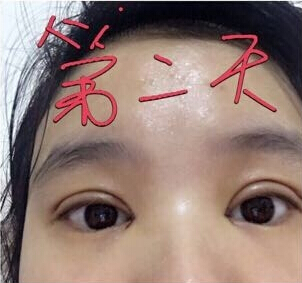 成都忠美整形医院杨忠价格7600做的双眼皮开眼角