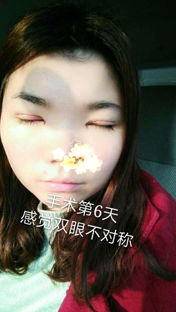 福州华窈傅怀康主任价格8500做的双眼皮提肌