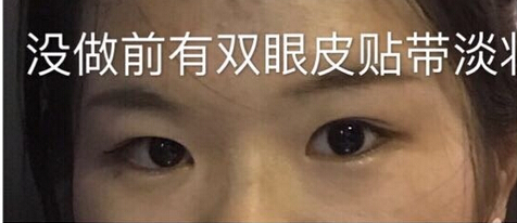 上海九院李茅医生做的全切双眼皮手术