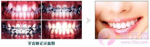 3分钟多方面解析牙套上“钢丝”的力量究竟有多神