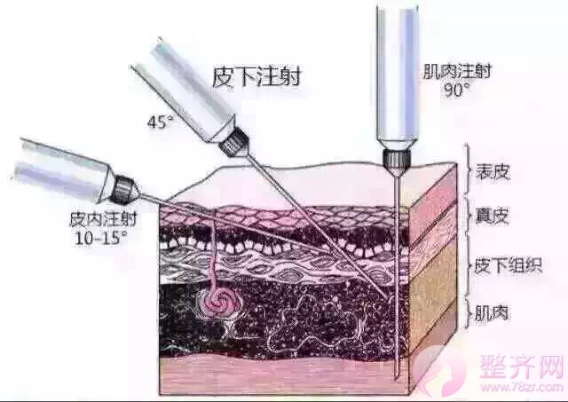 什么是P丙二醇线提升?