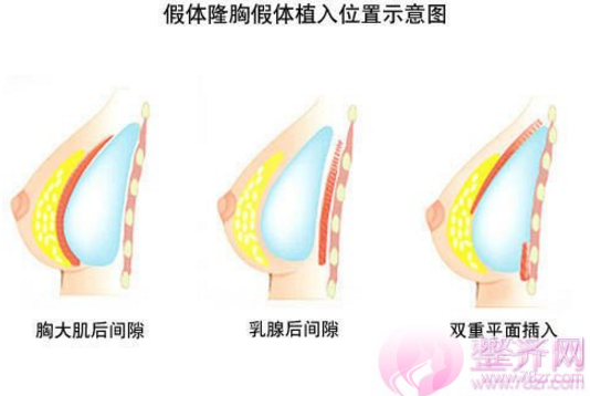 隆胸手术详细介绍