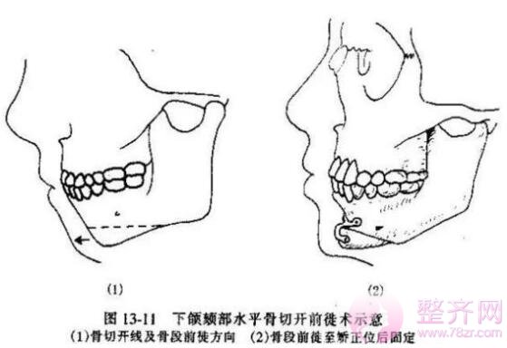 脸型太短怎么办？假体隆下巴没问题吗？