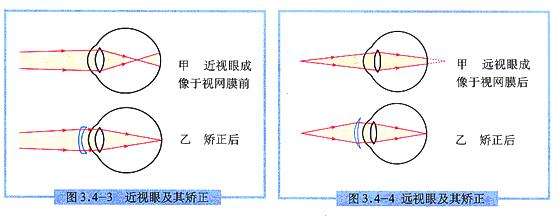 近视眼戴眼镜会让眼球变突出吗？