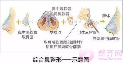 耳软骨PK鼻中隔软骨，哪种隆鼻较好？