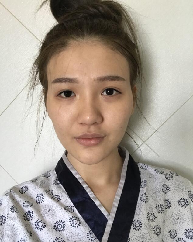 广州美莱整形罗延平医生鼻部手术隆鼻案例