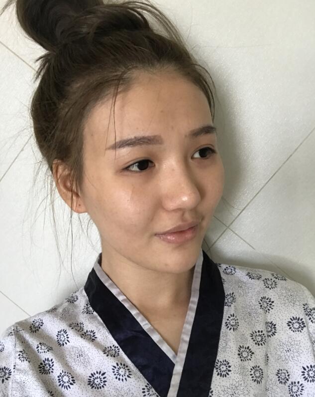 广州美莱整形罗延平医生鼻部手术隆鼻案例