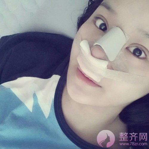 膨体隆鼻感染几率 教你如何避免隆鼻出现感染