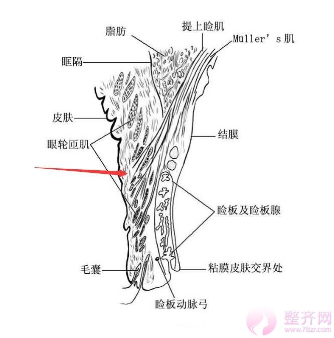 肿泡眼去脂后眼皮还是厚，是手术失败了吗？