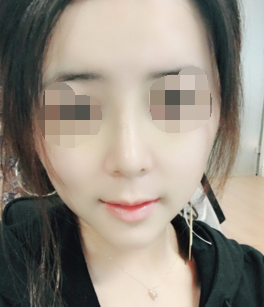 杭州格莱美鼻部手术+面部填充+垫下巴案例分享！