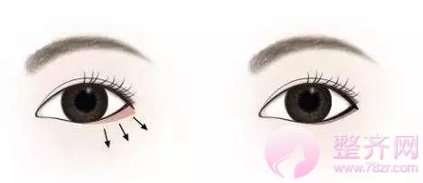 眼睑下至让你的眼睛温柔好看!