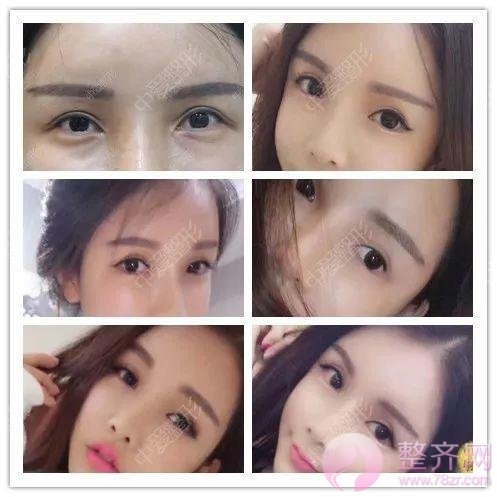 眼睑下至让你的眼睛温柔好看!