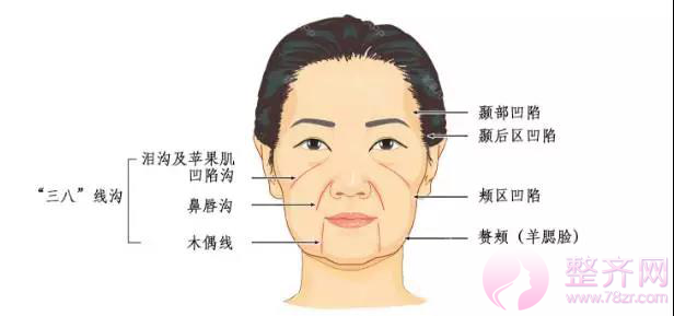 埋线提升提拉——提升、除皱、年轻化，抵抗地心引