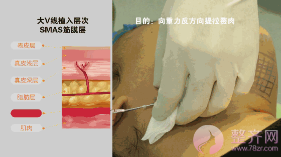 埋线提升提拉——提升、除皱、年轻化，抵抗地心引