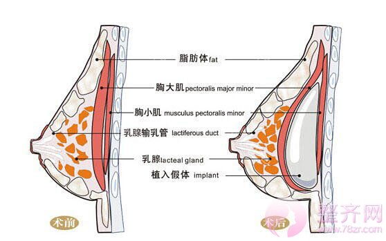 假体丰胸和自体脂肪究竟如何选择？