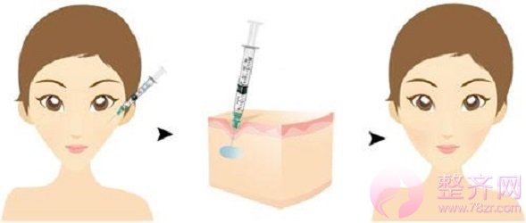 玻尿酸注射丰苹果肌