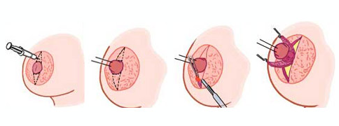 胸部整形乳头塑形术相关知识