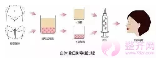 自体脂肪面部填充后，真的能年轻了10岁？