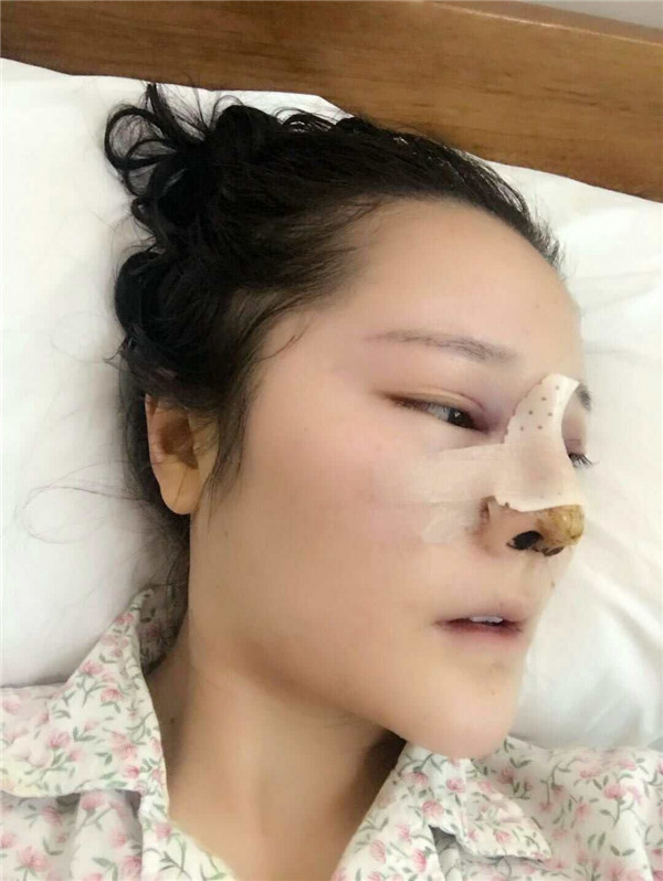 可爱的小仙女们，自从做了鼻部手术后，我觉得我在往网红的道路上越走越远了哈哈哈~~每天都是自拍自拍，进来看看我的美图案例吧！