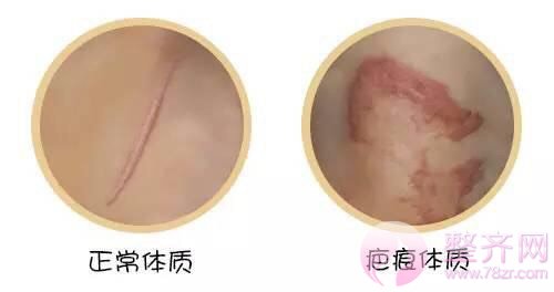 怎样才能知道自己是不是疤痕体质?