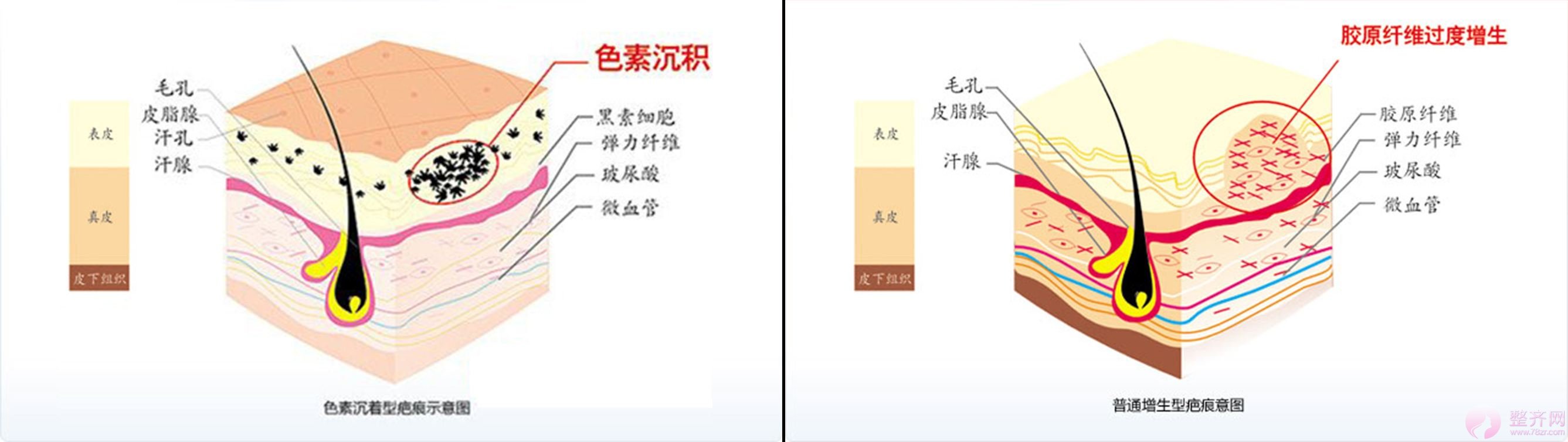 怎样才能知道自己是不是疤痕体质?