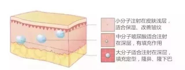 玻尿酸拯救你的颜值