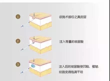 玻尿酸拯救你的颜值