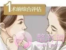做埋线提升，问老公，一问全剧终！