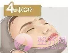 做埋线提升，问老公，一问全剧终！