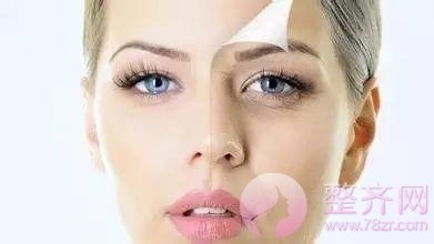 做埋线提升，问老公，一问全剧终！