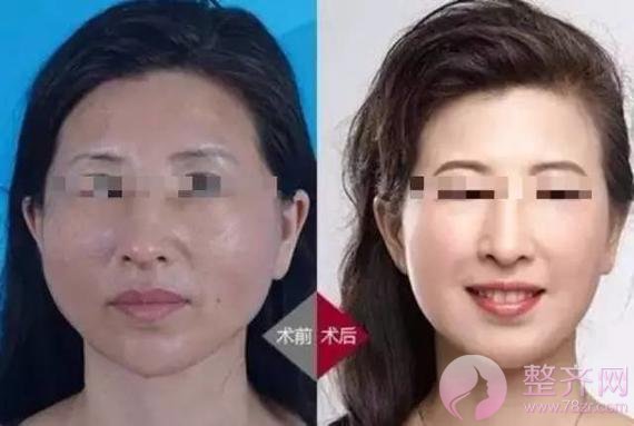 做埋线提升，问老公，一问全剧终！
