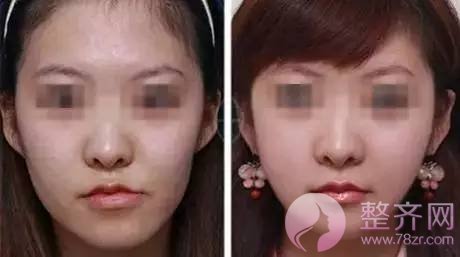 苹果肌到底好在哪里？