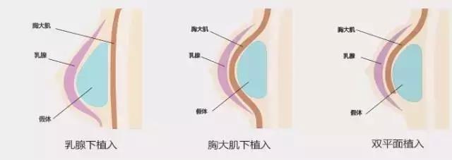 隆胸，究竟能不能瞒过火眼金睛的“老司机”？